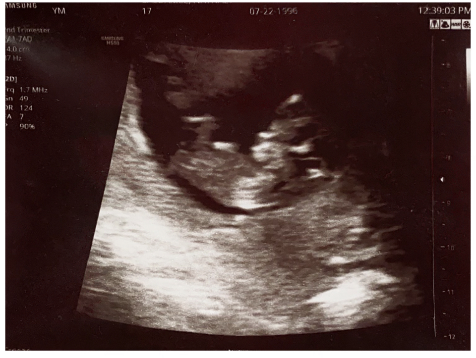 1st ultrasound